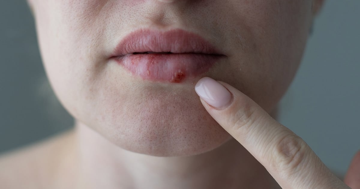 Un paso adelante contra el herpes que no responde: la FDA aprobó el pritelivir, el antiviral oral que llega después de casi treinta años sin nada nuevo